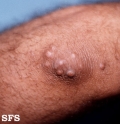 xanthoma tuberosum