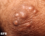 xanthoma tuberosum