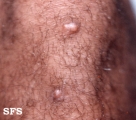 xanthoma tuberosum