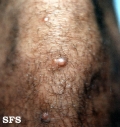 xanthoma tuberosum