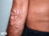 xanthoma tuberosum