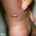 xanthoma tuberosum