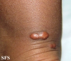 xanthoma tuberosum