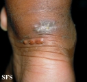 xanthoma tuberosum