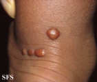 xanthoma tuberosum