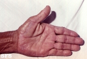 marginal keratoderma of the palms 
