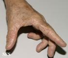 marginal keratoderma of the palms 