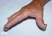 marginal keratoderma of the palms 
