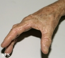 marginal keratoderma of the palms 