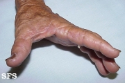 marginal keratoderma of the palms 