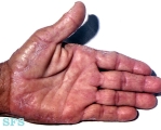marginal keratoderma of the palms 