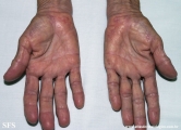 marginal keratoderma of the palms 