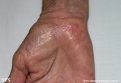 marginal keratoderma of the palms 