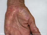 marginal keratoderma of the palms 
