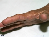 marginal keratoderma of the palms 