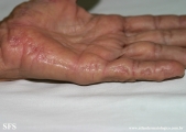 marginal keratoderma of the palms 