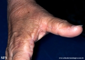 marginal keratoderma of the palms 