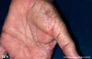 marginal keratoderma of the palms 