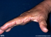 marginal keratoderma of the palms 