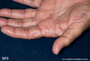 marginal keratoderma of the palms 