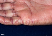 marginal keratoderma of the palms 