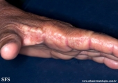 marginal keratoderma of the palms 