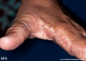 marginal keratoderma of the palms 