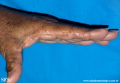 marginal keratoderma of the palms 