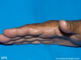 marginal keratoderma of the palms 