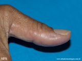 marginal keratoderma of the palms 