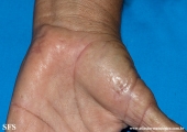 marginal keratoderma of the palms 