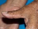 marginal keratoderma of the palms 