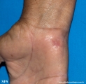 marginal keratoderma of the palms 