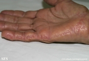 marginal keratoderma of the palms 