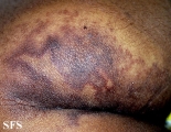 angioma-sudoriparous angioma