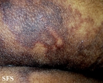 angioma-sudoriparous angioma
