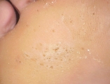 pitted keratolysis