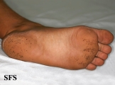 pitted keratolysis