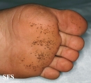 pitted keratolysis