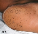 pitted keratolysis