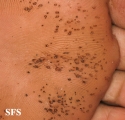 pitted keratolysis