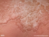 pitted keratolysis