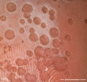 pitted keratolysis