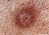 trichilemmoma