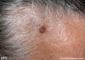 trichilemmoma