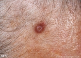 trichilemmoma