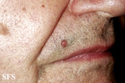 trichilemmoma