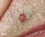 trichilemmoma