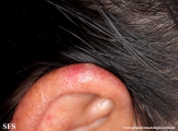 chondrodermatitis nodularis chronica helicis
