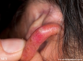 chondrodermatitis nodularis chronica helicis